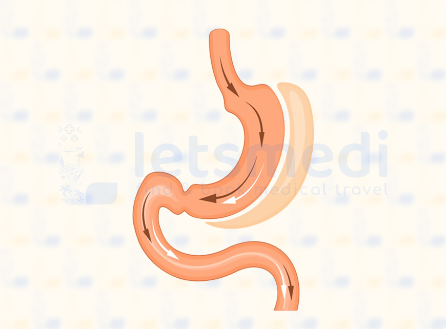 Gastric Sleeve in Istanbul, Turkey • Cost & Reviews