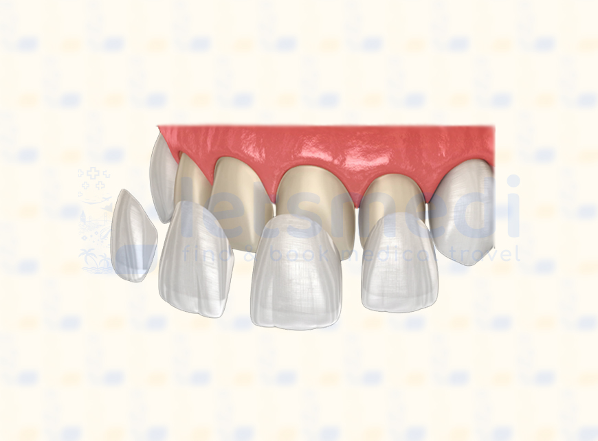 Porcelain Veneers in Turkey • Cost & Reviews