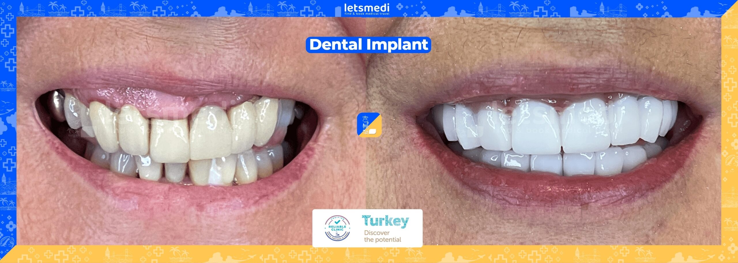 dental implant