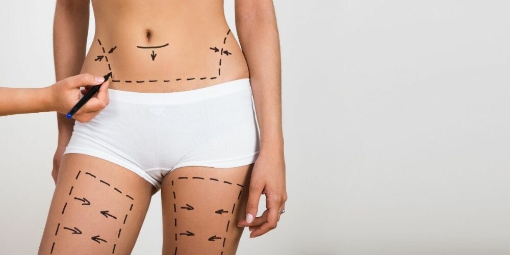 Liposuction Cost in UK