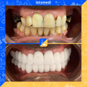 1-new_Before_After_Sifa