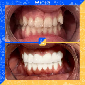 3-new_Before_After_Celina