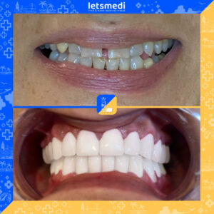 4-new_Before_After_Celina