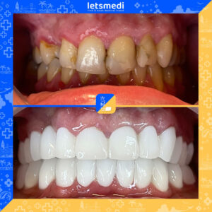 5-new_Before_After_Celina