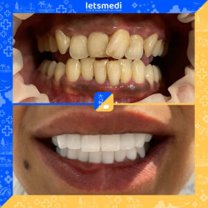 7-new_Before_After