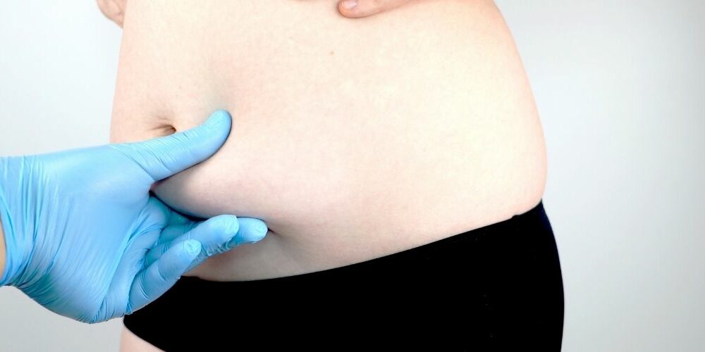 Extended Tummy Tuck Cost in the UK
