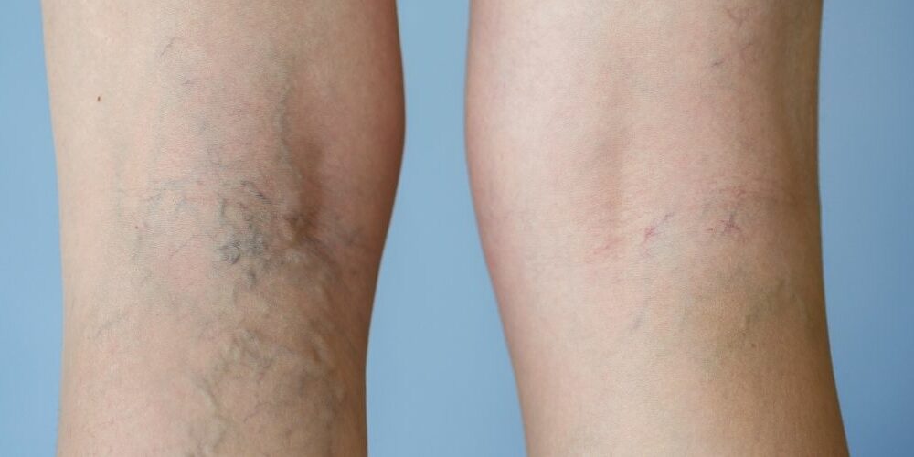 Laser Vein Removal Cost in the UK