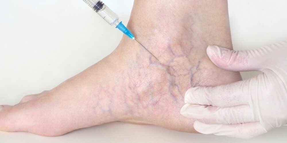 Sclerotherapy Cost in the UK