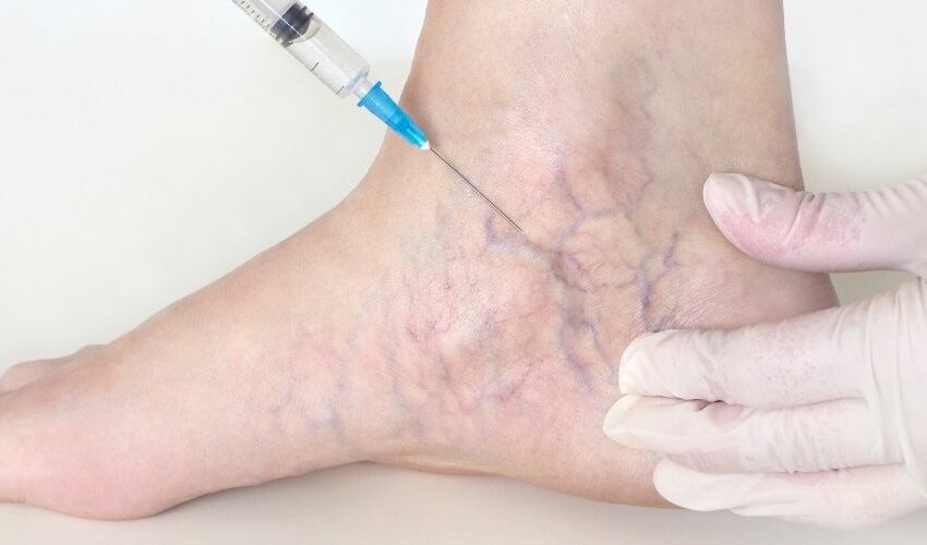 Sclerotherapy Cost in the UK
