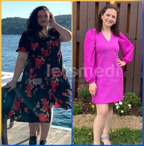 gastric bypass before after3
