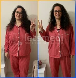 mini gastric bypass before and after3