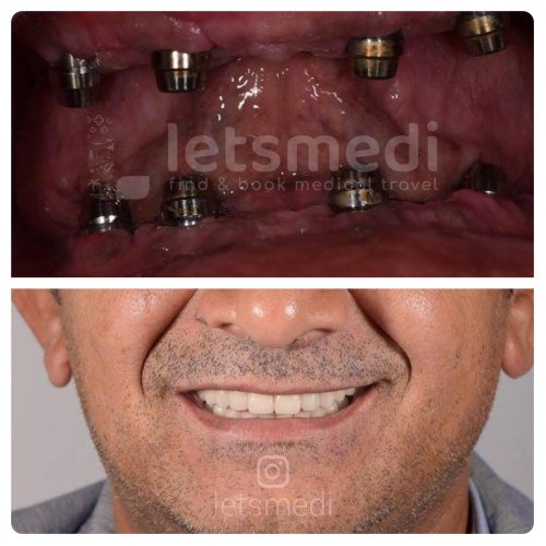 all on 4 dental implants turkey before after