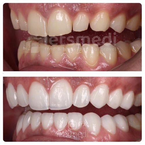 composite veneers before and after turkey