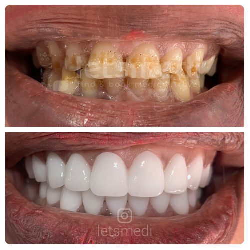 dental crown before and after