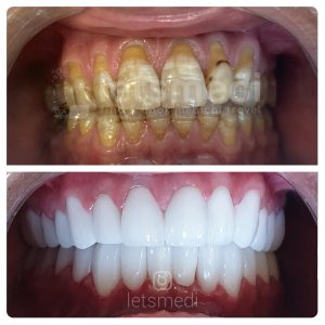dental crown before and after pictures