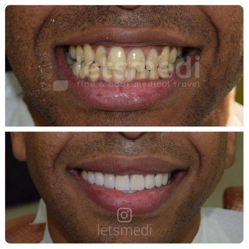 dental crown before and after turkey