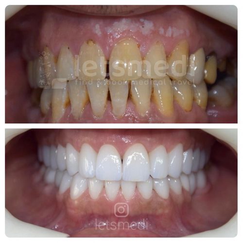 dental crown pictures before and after