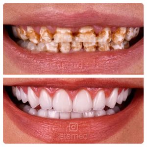 dental crown pictures before and after istanbul turkey