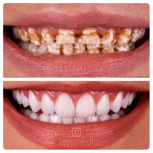 dental crown pictures before and after istanbul turkey