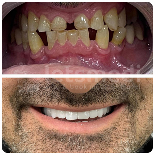 dental implants turkey before after