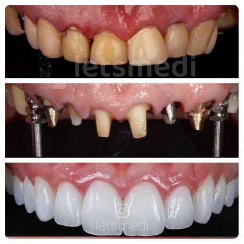 dental implants turkey istanbul before after