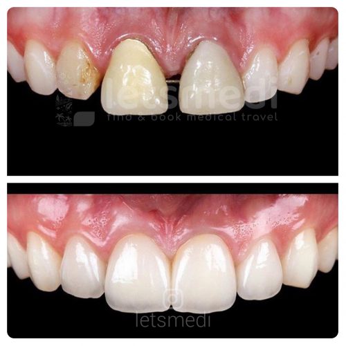 dental veneers before and after turkey