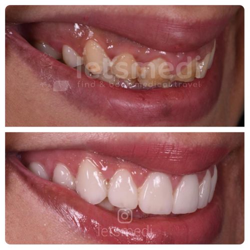 front dental crown before and after