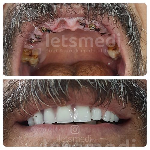 full moth dental implants istanbul turkey before after