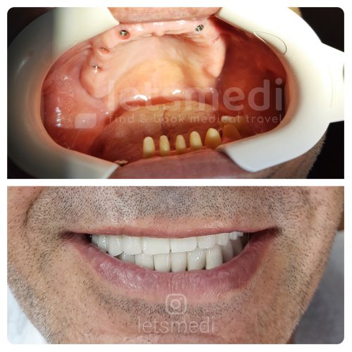 full mouth dental implants turkey before after