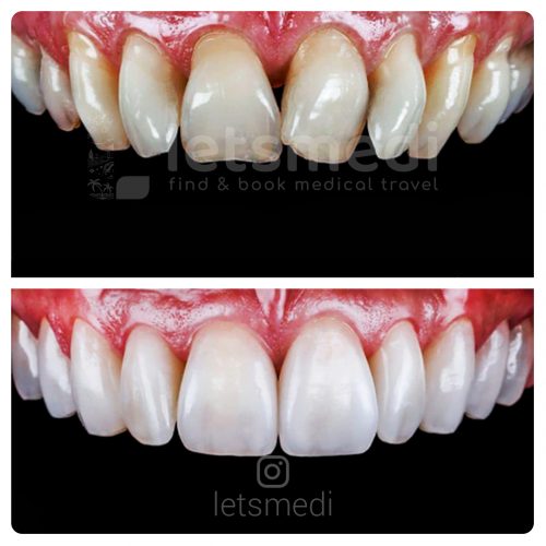porcelain veneers before and after turkey istanbul