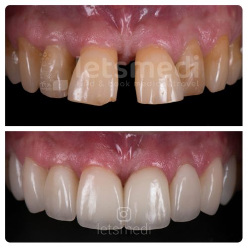 teeth veneers before and after turkey