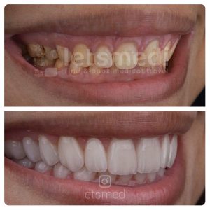 veneers before and after istanbul turkey
