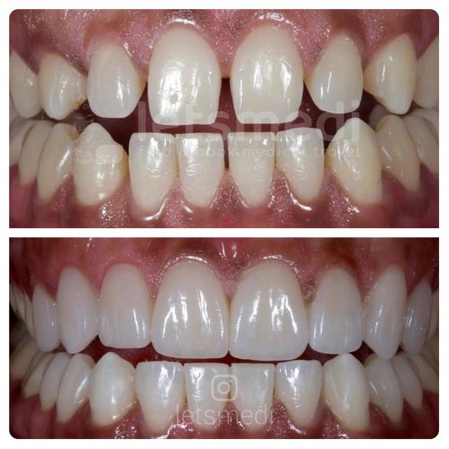 veneers before and after picture turkey