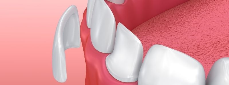 What Happens to Your Teeth Under Veneers?