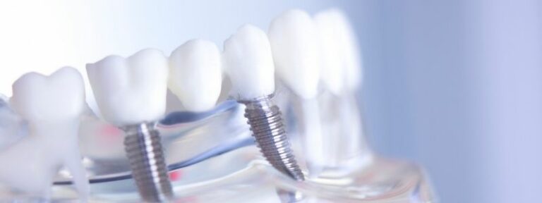 Are You Putting Your Dental Implants at Risk by Smoking?