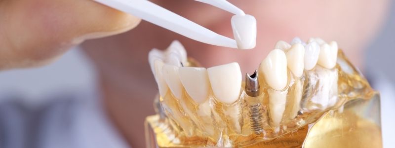 Is Swelling Normal After Dental Implants?