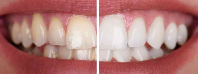  Zirkonyum Diş Nasıl Beyazlatılır?