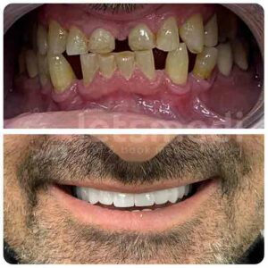 dental-implants-turkey-before-after-3-2
