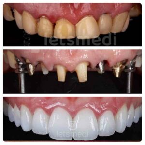 dental-implants-turkey-istanbul-before-after-2