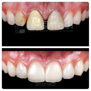 dental-veneers-before-and-after-turkey