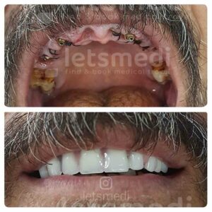 full-moth-dental-implants-istanbul-turkey-before-after-2