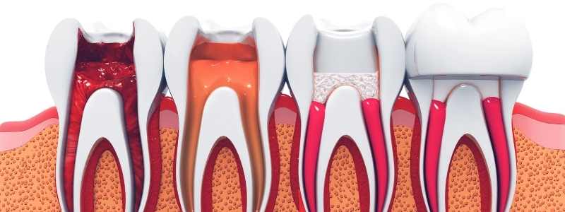 Kanal Tedavisi Sonrası Diş Üstüne Basamama Normal mi?