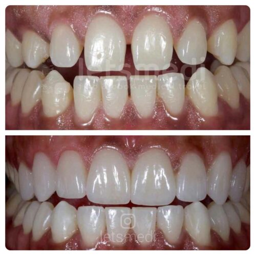 veneers-before-and-after-picture-turkey