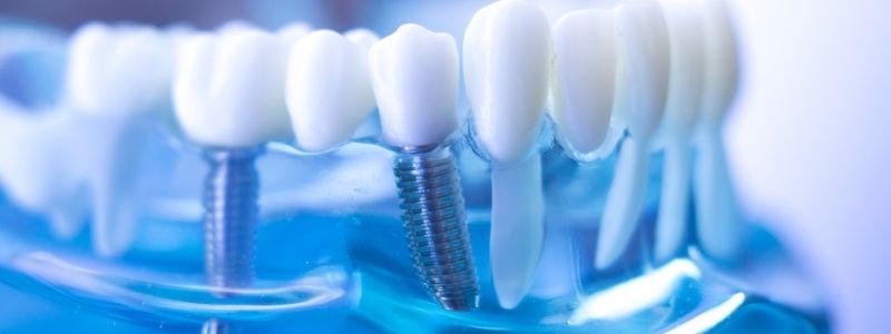 Diş İmplantı Tedavisinden Önce Neler Yapılır? İmplant Tedavi Aşamaları Nelerdir ?
