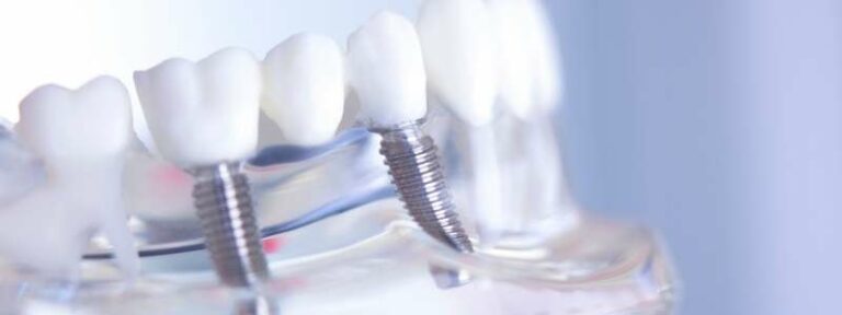 Recovery after same day dental implants
