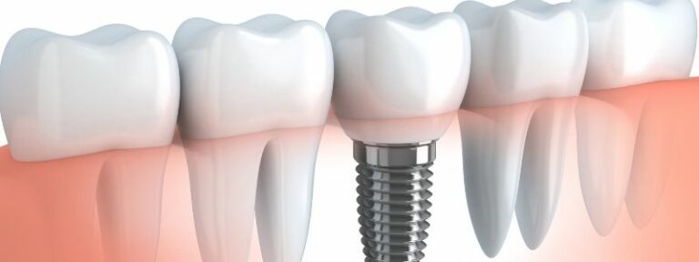Implantat Arten » Welche Zahnimplantat-Arten gibt es?