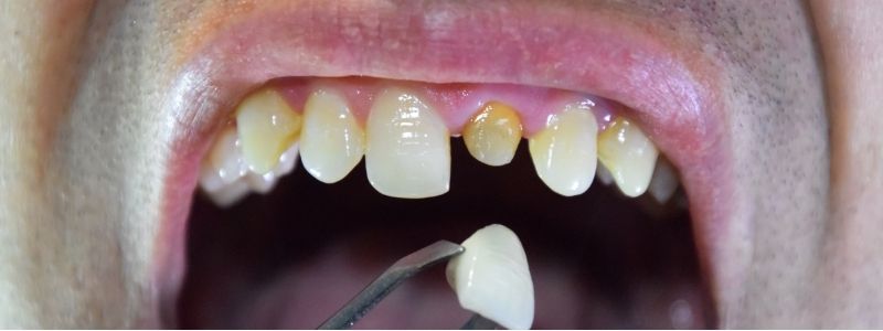Bluterguss nach Zahn Implantat