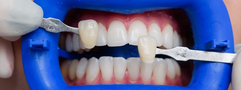 Was passiert mit den Zähnen unter den veneers?