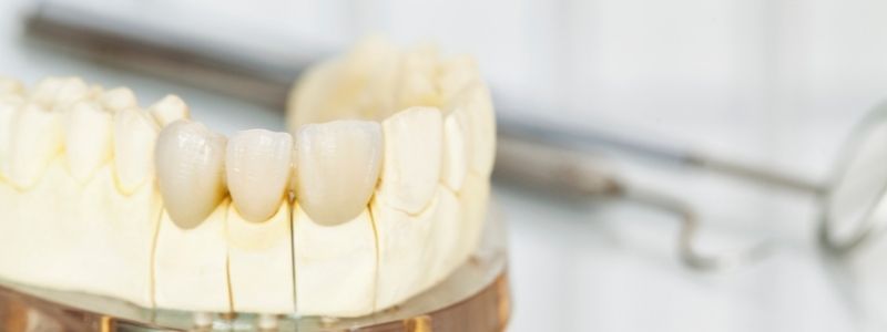 Welche Zahnkrone ist am günstigsten?