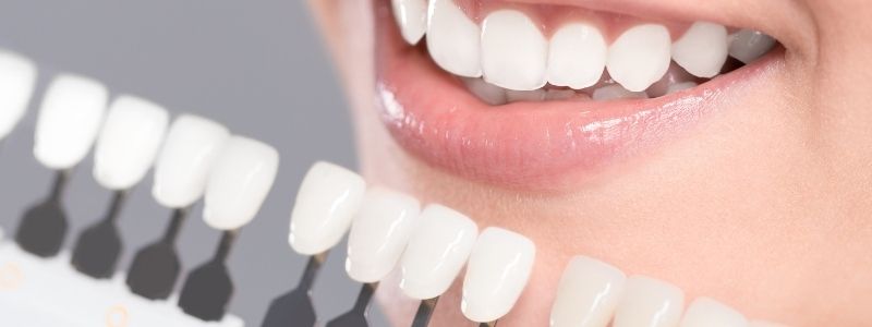 Welche Zahnkrone ist die beste?